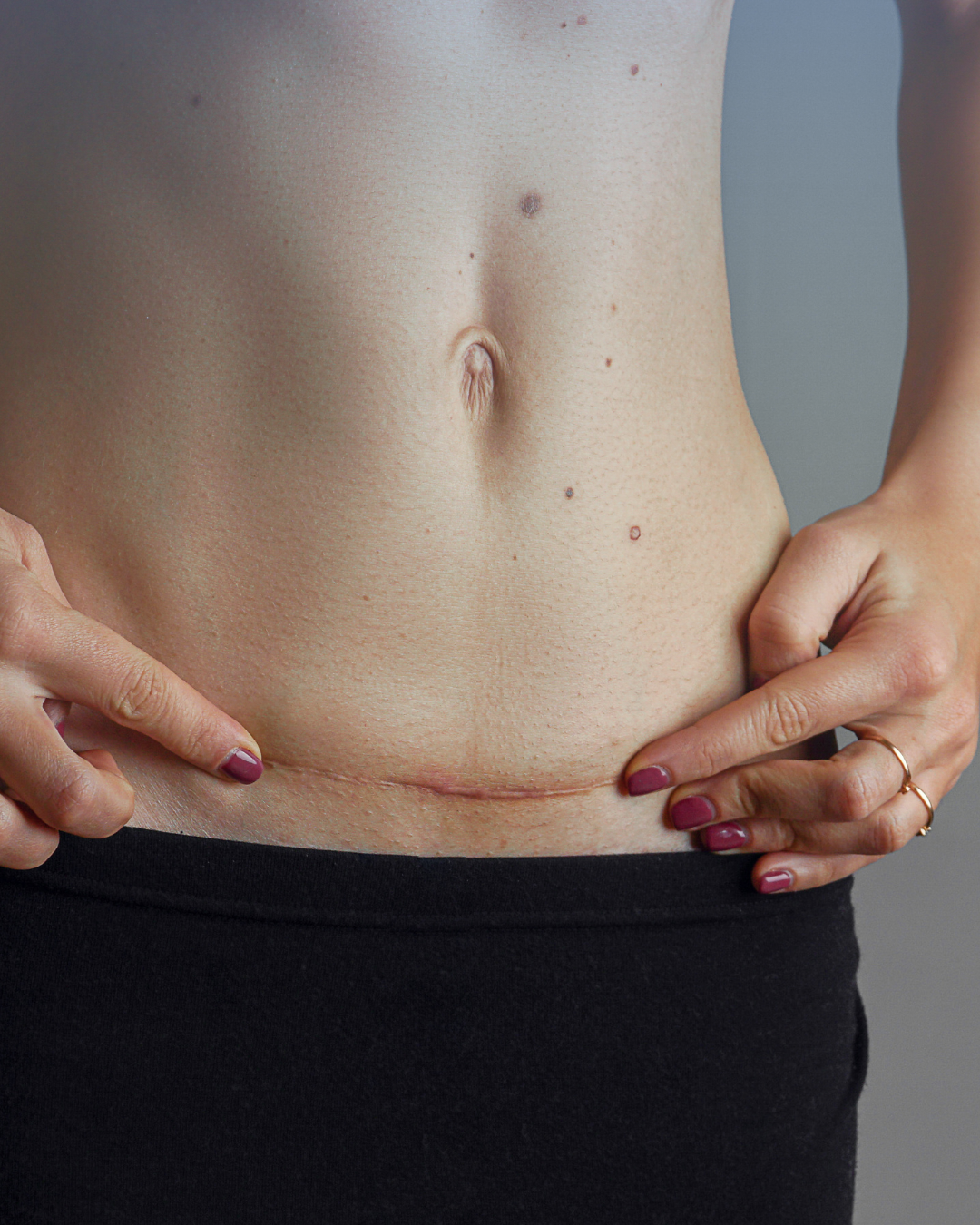 Ako sa starať o jazvu po operácii?