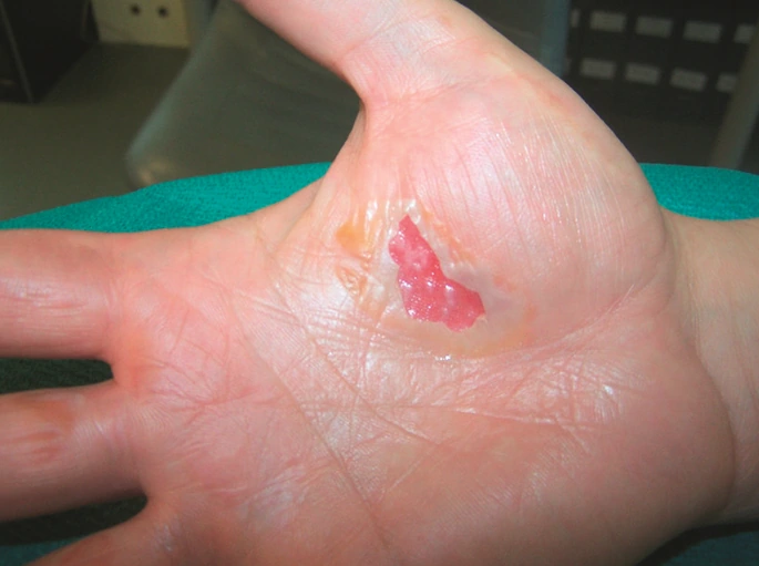 Popáleniny 2.-3.supnrě na dlani ruky. Rychlá léčba s pomocí ActiMaris gelu a roztoku Sensitiv.