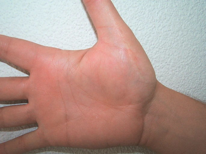 Zahojená rána po popálenině. Hluboké rány umí léčit ActiMaris.