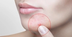 Žena s akné na brade – ActiMaris pomáha pri rýchlom hojení a zmiernení zápalu