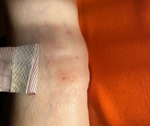 hojeni-po-rigenoma-actimaris