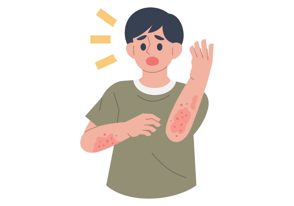 Puchýře, bolest a dlouhé hojení. Na popáleniny druhého stupně zkuste ActiMaris produkty.