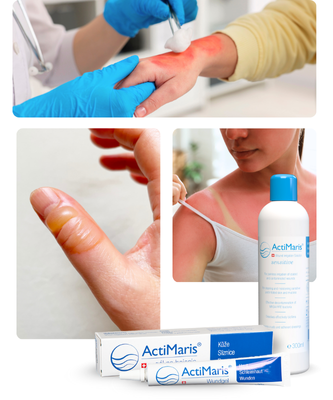 Popálená kůže od ohně nebo horké plotny? Spálená od slunce? Rychle se zbavte nepříjemného pálení, podráždění a regenerujte kůži s ActiMaris.