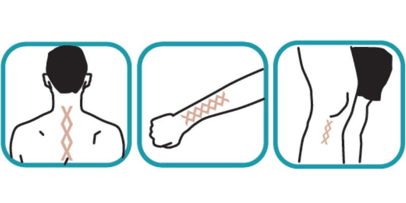 Príklady, ako pracovať s tejpovacou páskou RIGENOMA proti bolesti, opuchom a regenerácii pokožky.