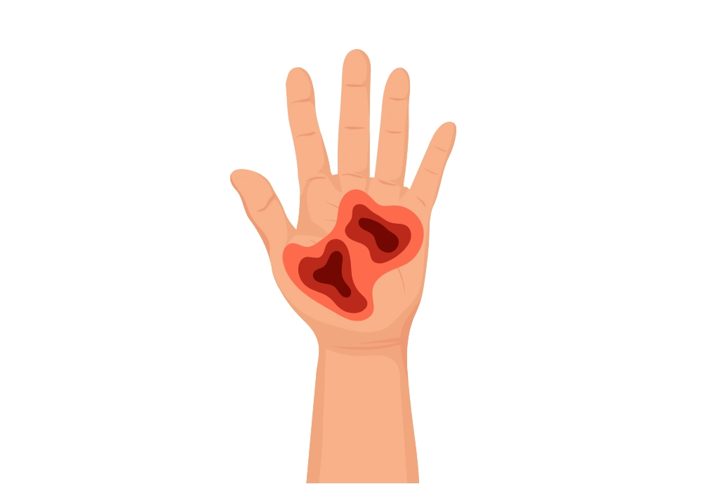 Zakročte v hojení popálenin 3. stupně, které mohou být těžko hojící.